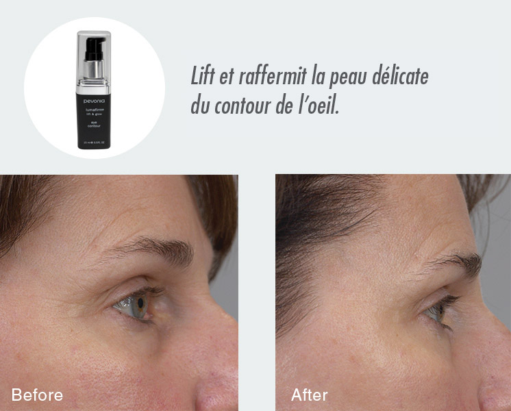 Résultats Avant Après Contour des Yeux